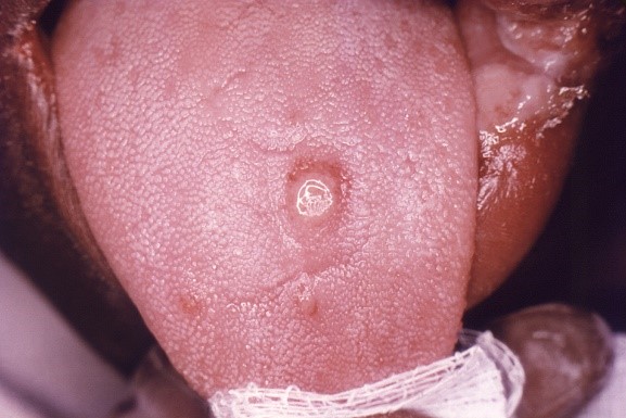 Syphilis Images
